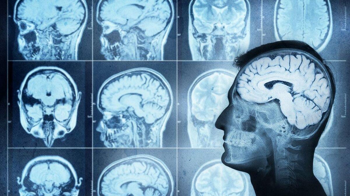 RebrAIn lève 3,7M€ pour révolutionner la neurochirurgie
